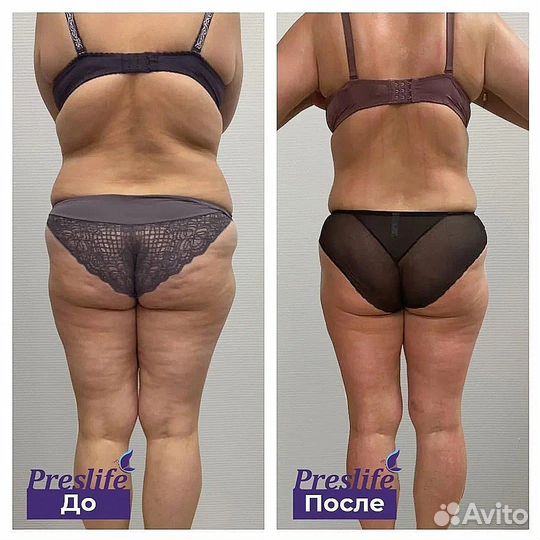 Хотите стройное тело Похудение 9 процедур