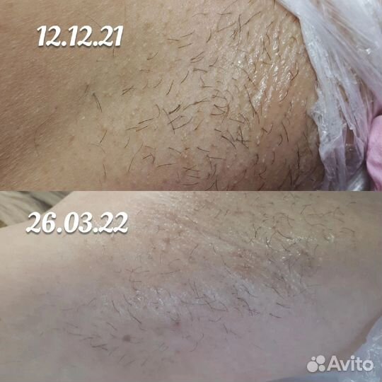 Электроэпиляция