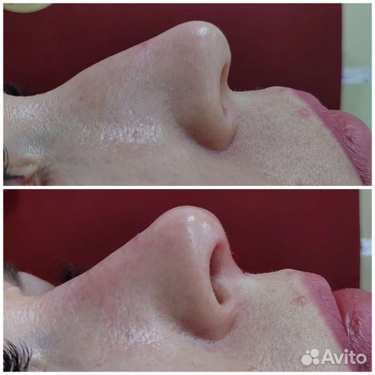 Безоперационная ринопластика