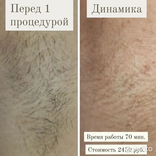 Электроэпиляция