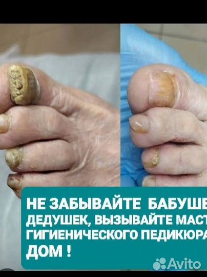 Гигиенический педикюр