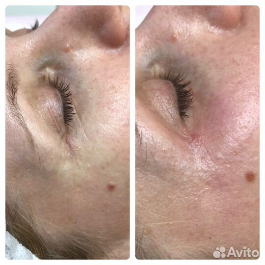 Скульптурный массаж лица