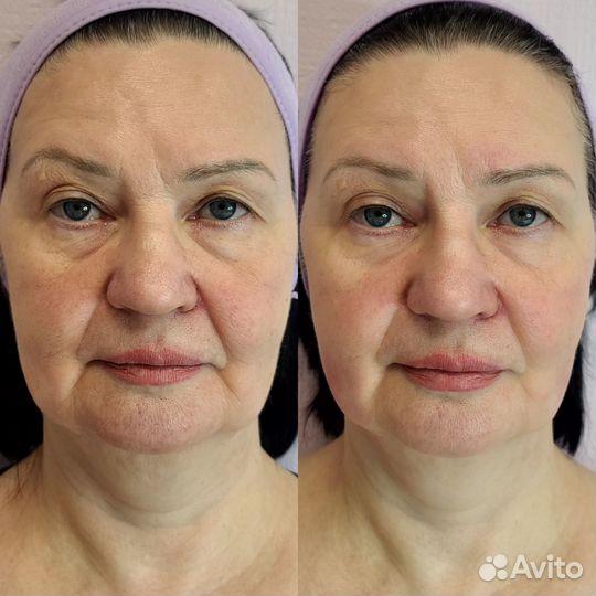 Массаж лица