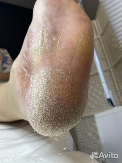 Педикюр Подологическая обработка