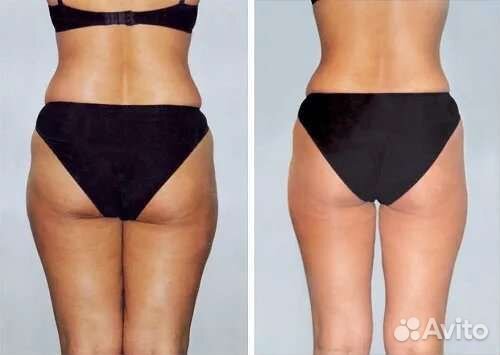 Lpg массаж, уз кавитация, РФ лифтинг и т. д