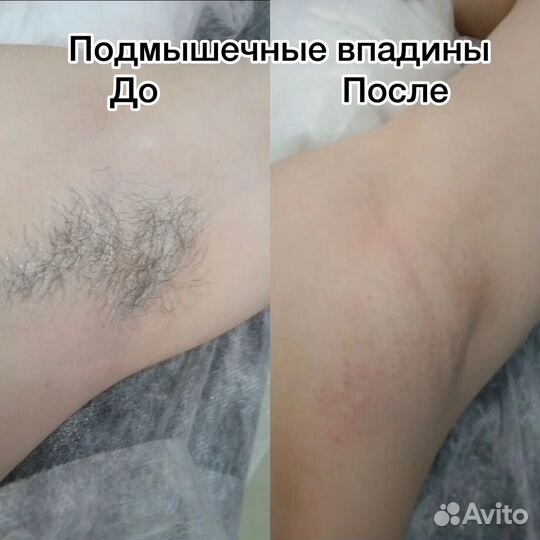 Депиляция воском