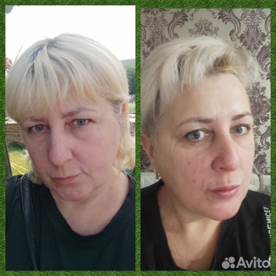 Ботокс для лица