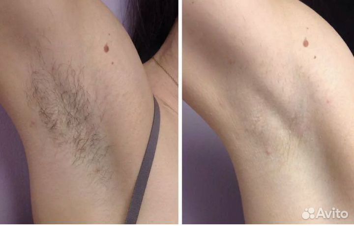 Лазерная эпиляция