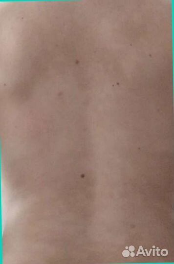 Мазь от псориаза