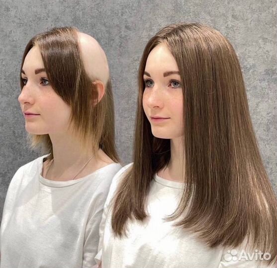 Система замещения волос