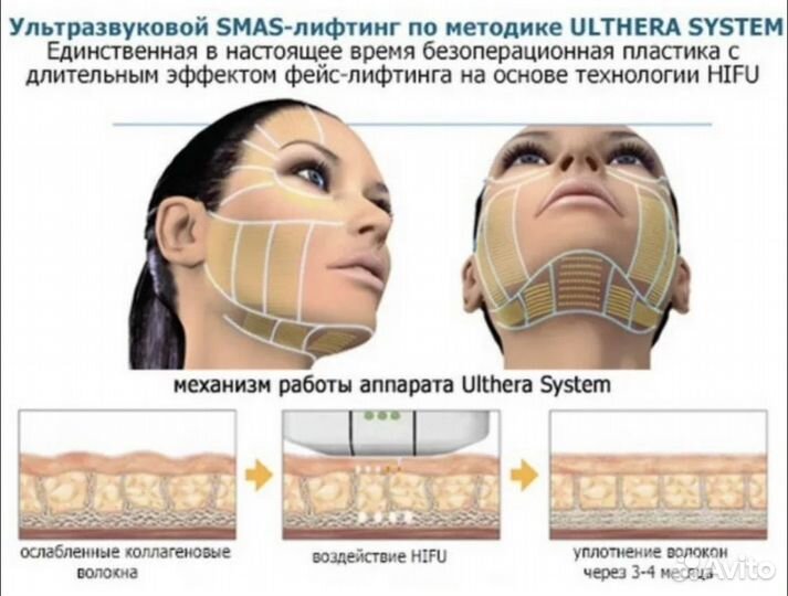 Липосоникс liposonix