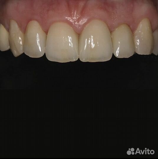 Починка зубных протезов