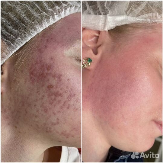 Лазерная шлифовка с охлаждением