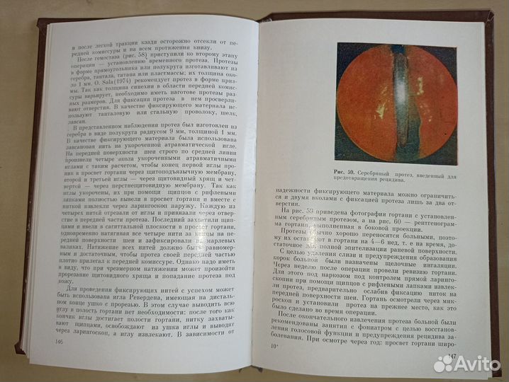 Микроларингоскопия и эндоларингеальная микрохирург