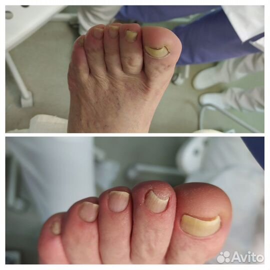 Подолог проблемный педикюр протезирование скоба
