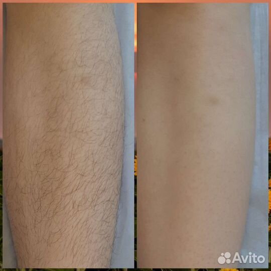 Шугаринг Фитоэпиляция