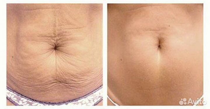 Кавитация ультразвуковая-коррекция фигуры
