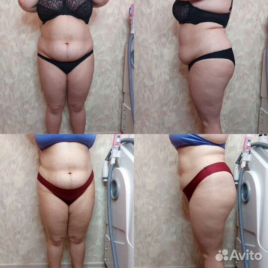 LPG массаж/ кавитация/ вибромассаж