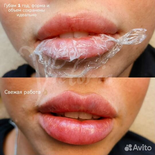 Косметология. уз Чистка. Rf лифтинг