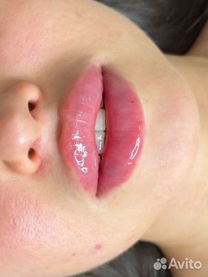 TCA-пилинг лица