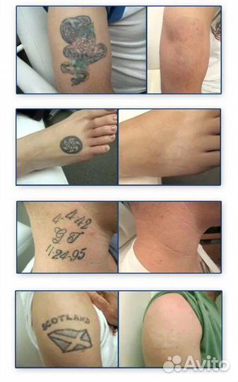 Удаление татуажа и тату
