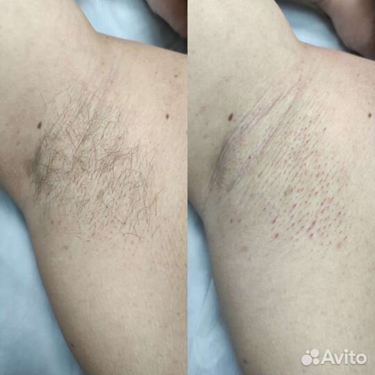 Депиляция воском: глубокое бикини