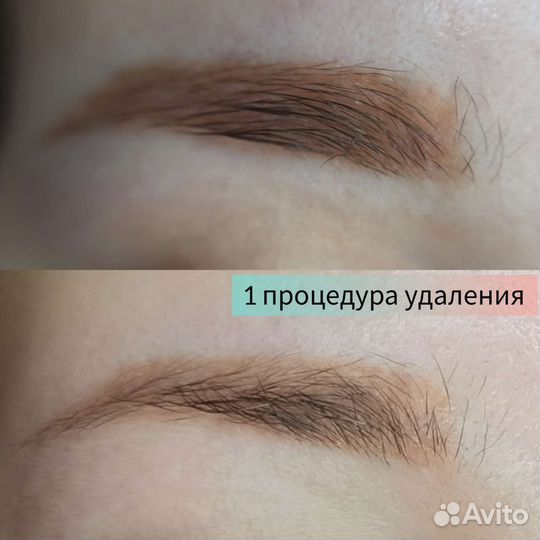 Удаление татуажа и татуировок ремувером