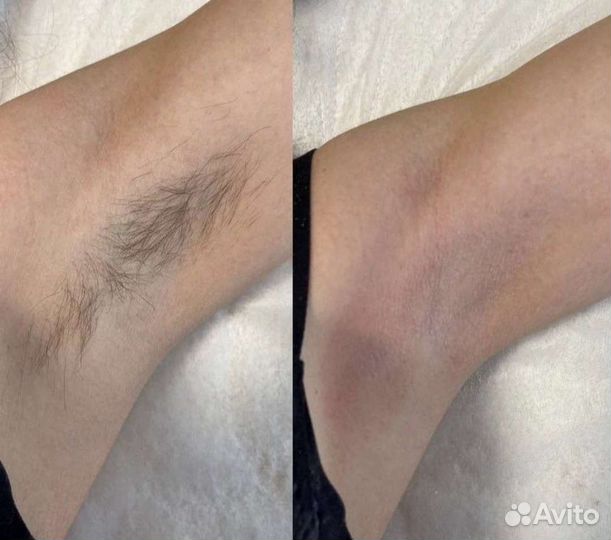 Шугаринг на дому сахарной пастой