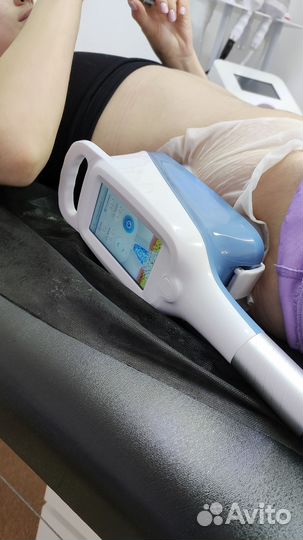 Криолиполиз