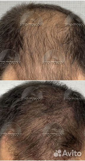 Имитация волос (фолликул), трихопигментация, smp