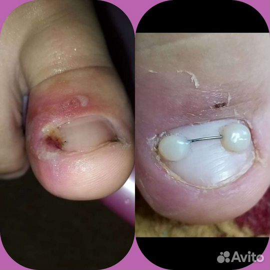 Педикюр подолог