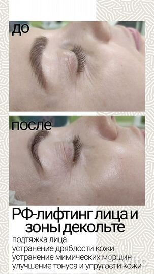 Модель на криолиполиз, вакуумный массаж, кавитация