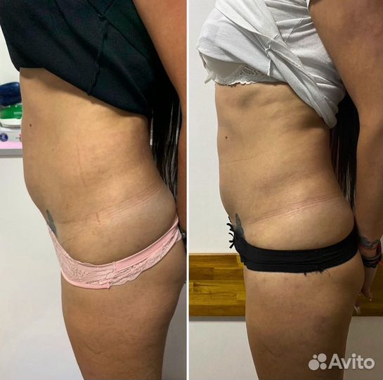 Криолиполиз липосакция без операции