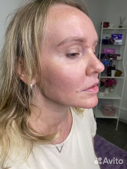 Увеличение губ