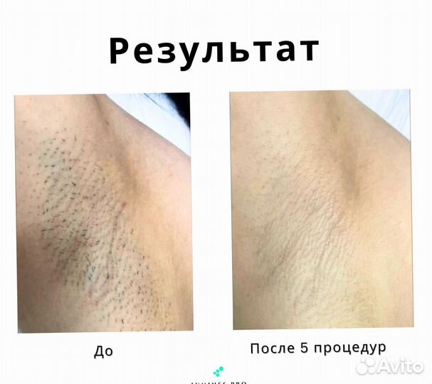 Диодный лазер Лю’минес Max One 1200вт