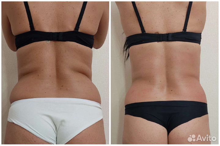 Аппаратная коррекция фигуры/ручной массаж