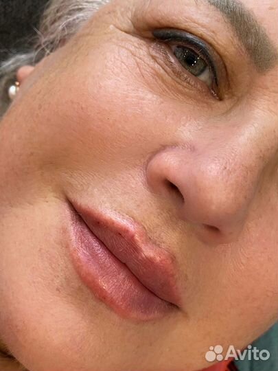 Увеличение губ