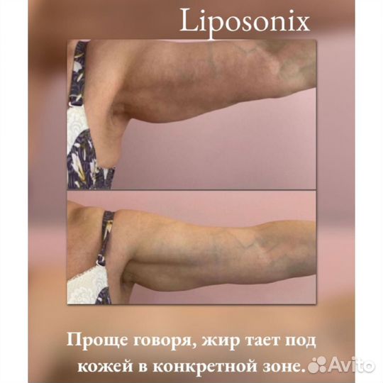 Коррекция фигуры не требующая курса(липосоникс)