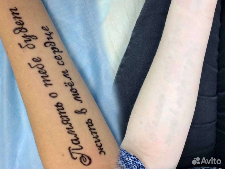 Удаление тату