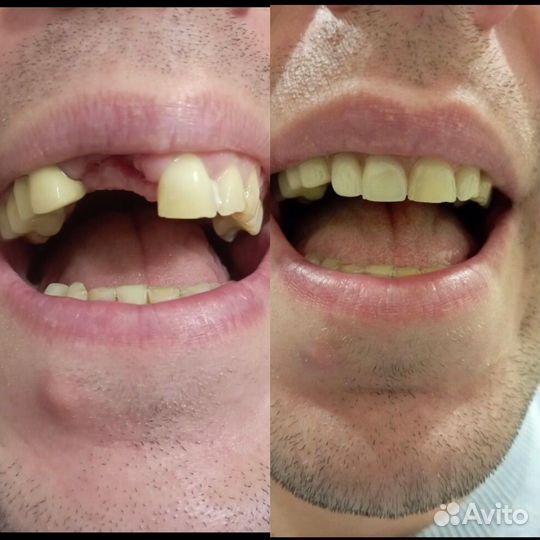 Протезирование и ремонт зубных протез