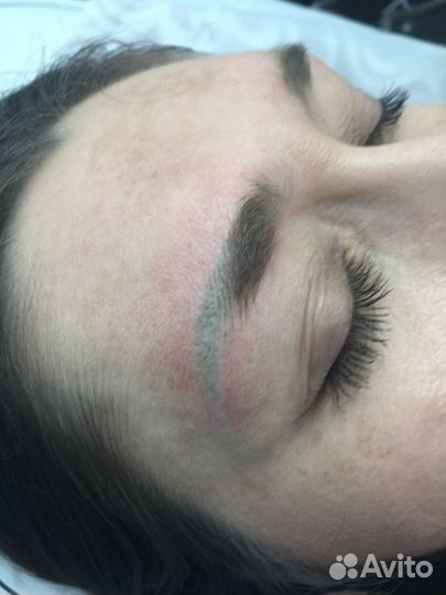 Удаление татуажа,тату, карбоновый пилинг, обучение