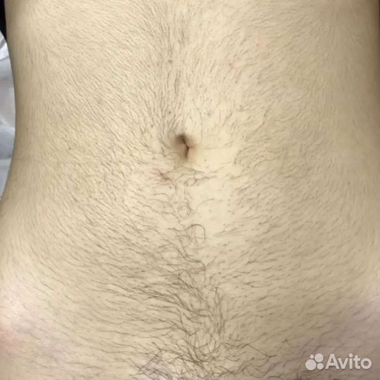 Электроэпиляция