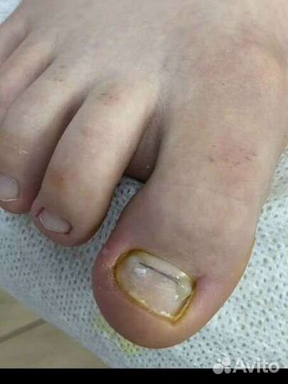 Установка титановой нити, вросший ноготь