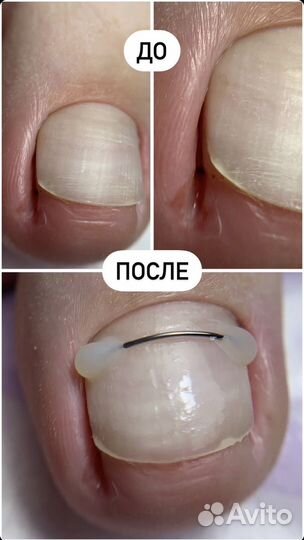 Медицинский педикюр подолог