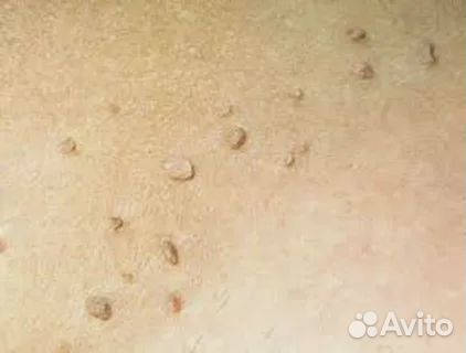 Удаление папилом, родинок, шипиц