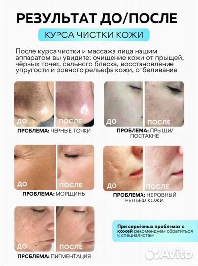 Ультра звуковая чистка лица