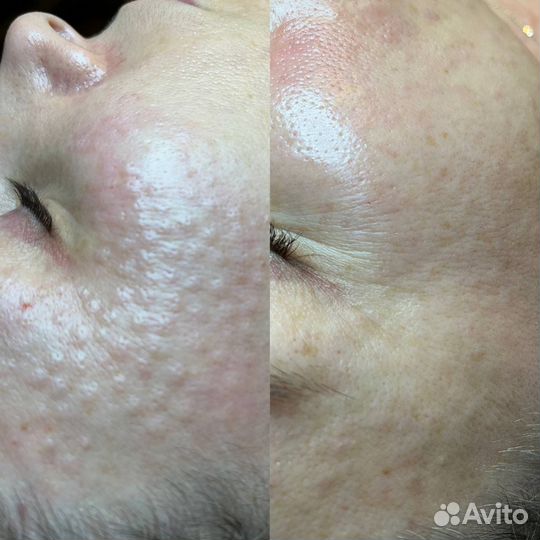 Мезотерапия