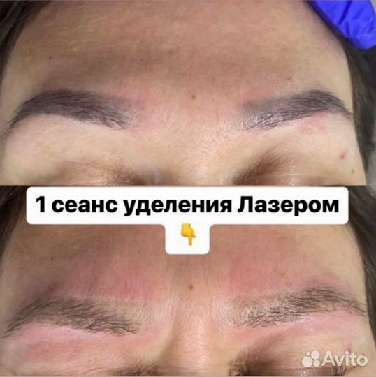 Лазерное удаление тату за одну процедуру*