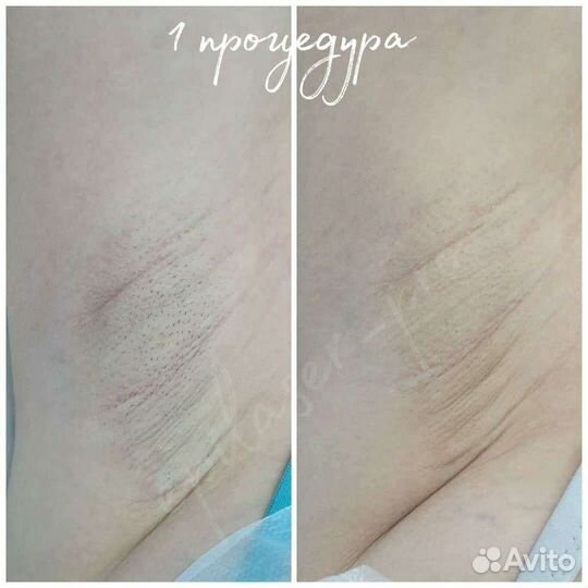 Лазерная эпиляция