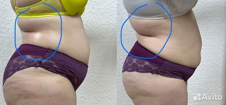 Аппаратный массаж. Кавитация, вакуумный массаж